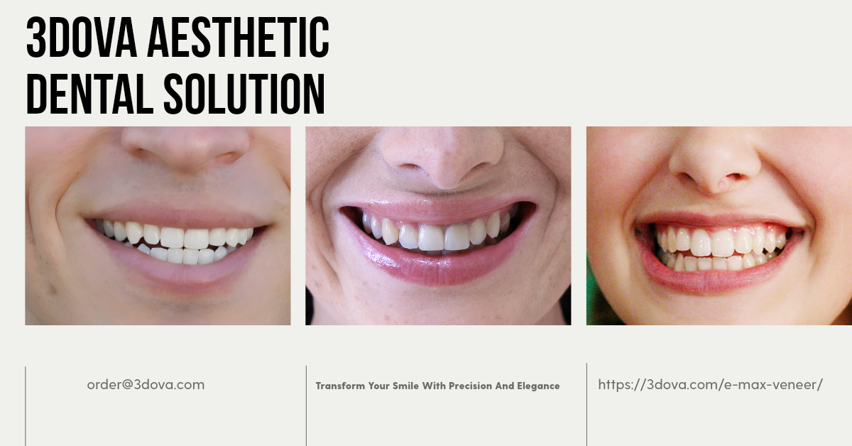 E-Max Veneer Smile Design