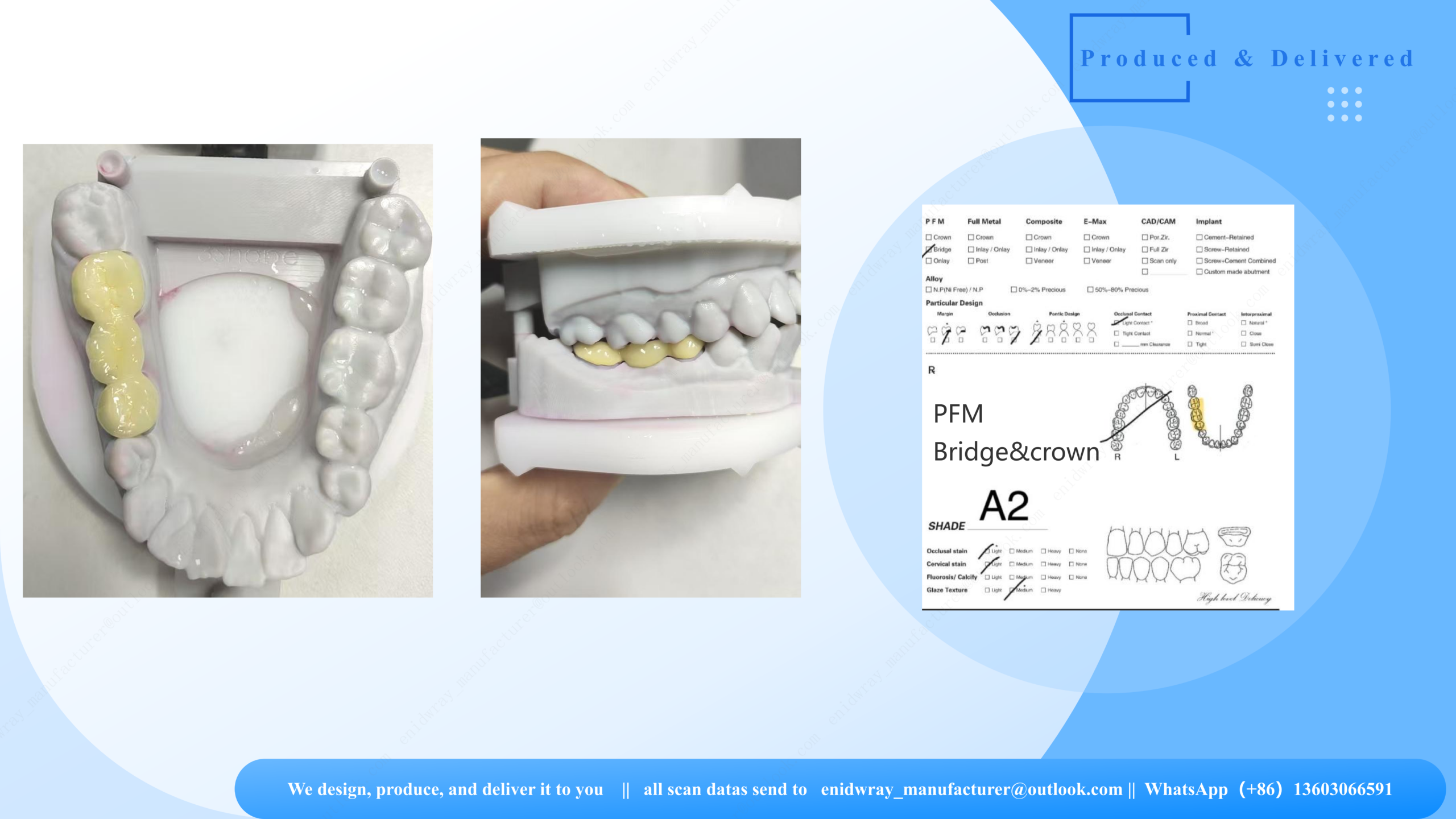 PFM 3D Crown Bridge | High-Precision Printing & CAD/CAM Fit