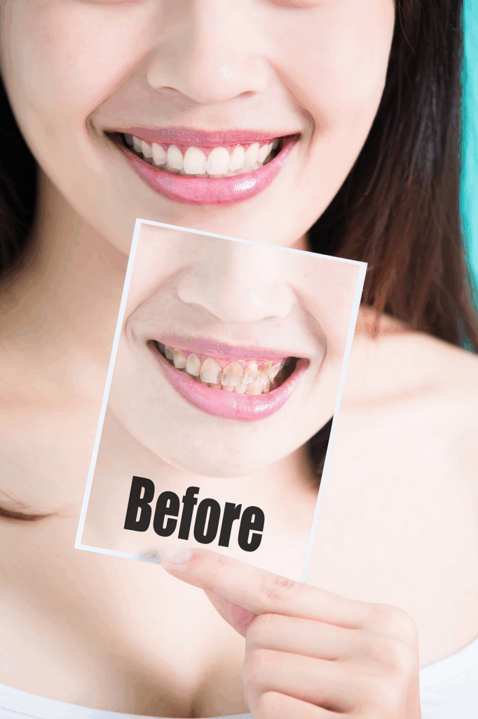 Cercon zirconia anterior crown with high translucency