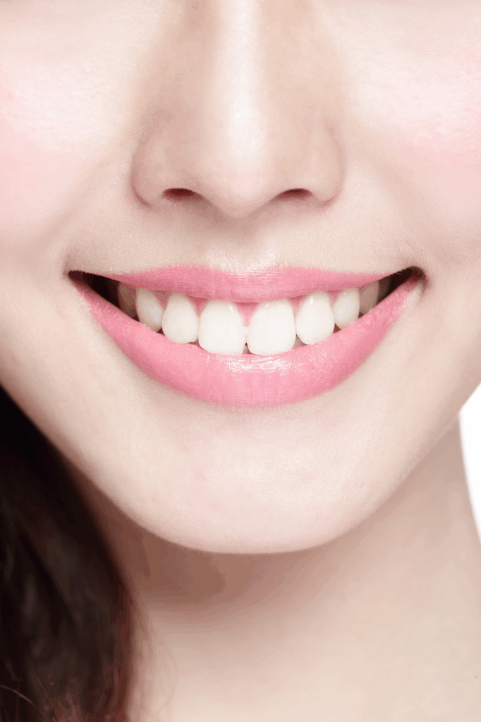 UPCERA zirconia bridge for posterior teeth