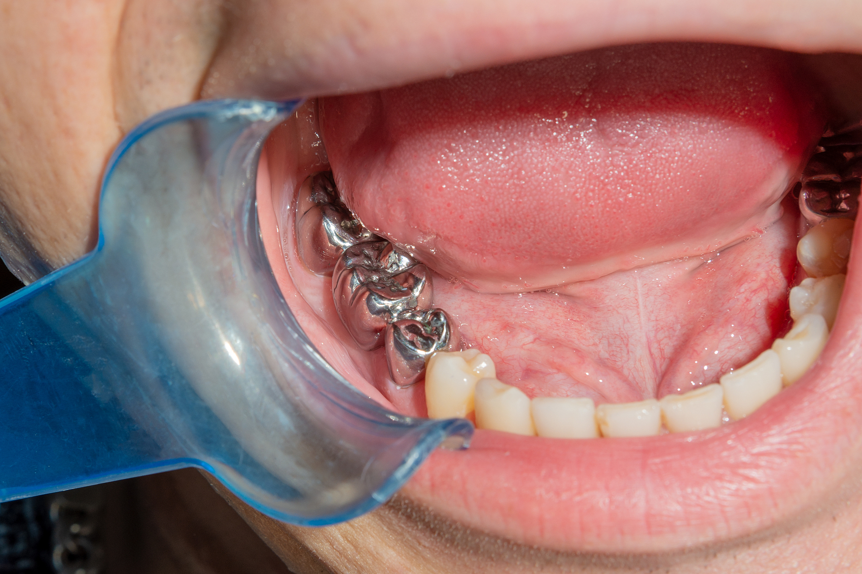 full metal crown CAD CAM milled for posterior tooth