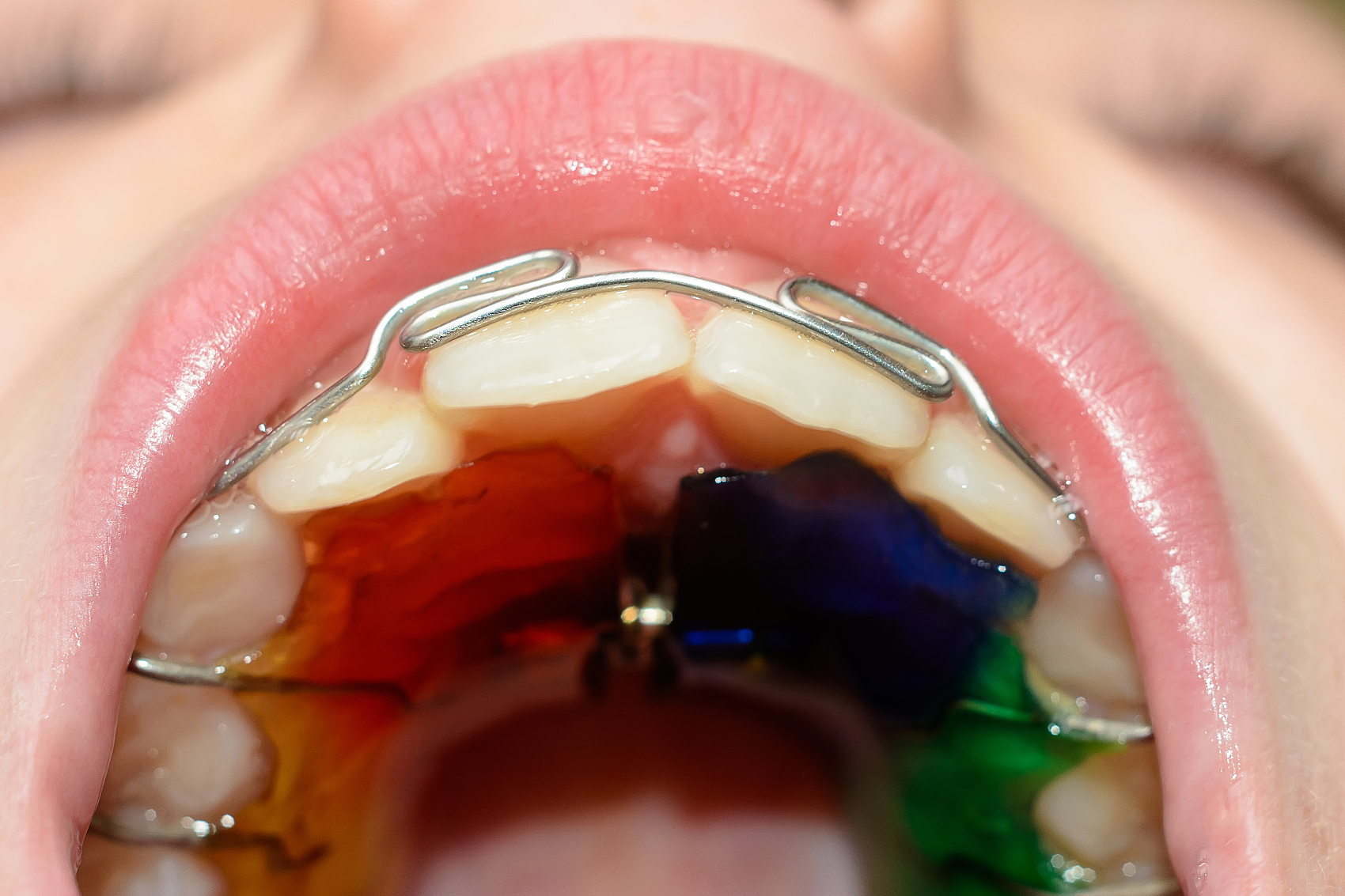 Hawley retainer with acrylic base and labial bow