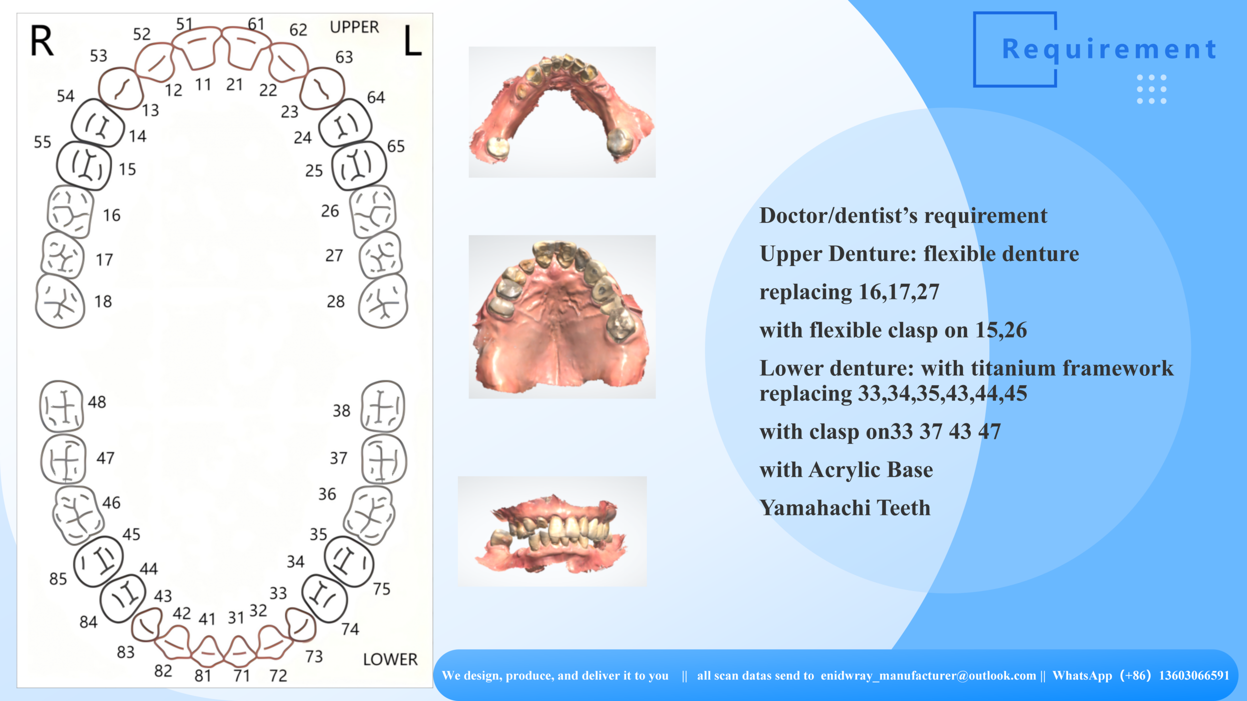 Titanium Framework & Flexible Denture Combination Case Study