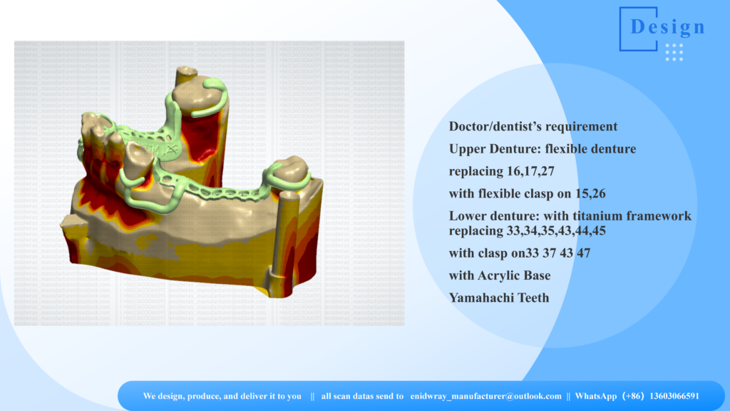  Upper flexible nylon denture and lower titanium framework with Yamahachi teeth mounted on a dental articulator for bite alignment check.