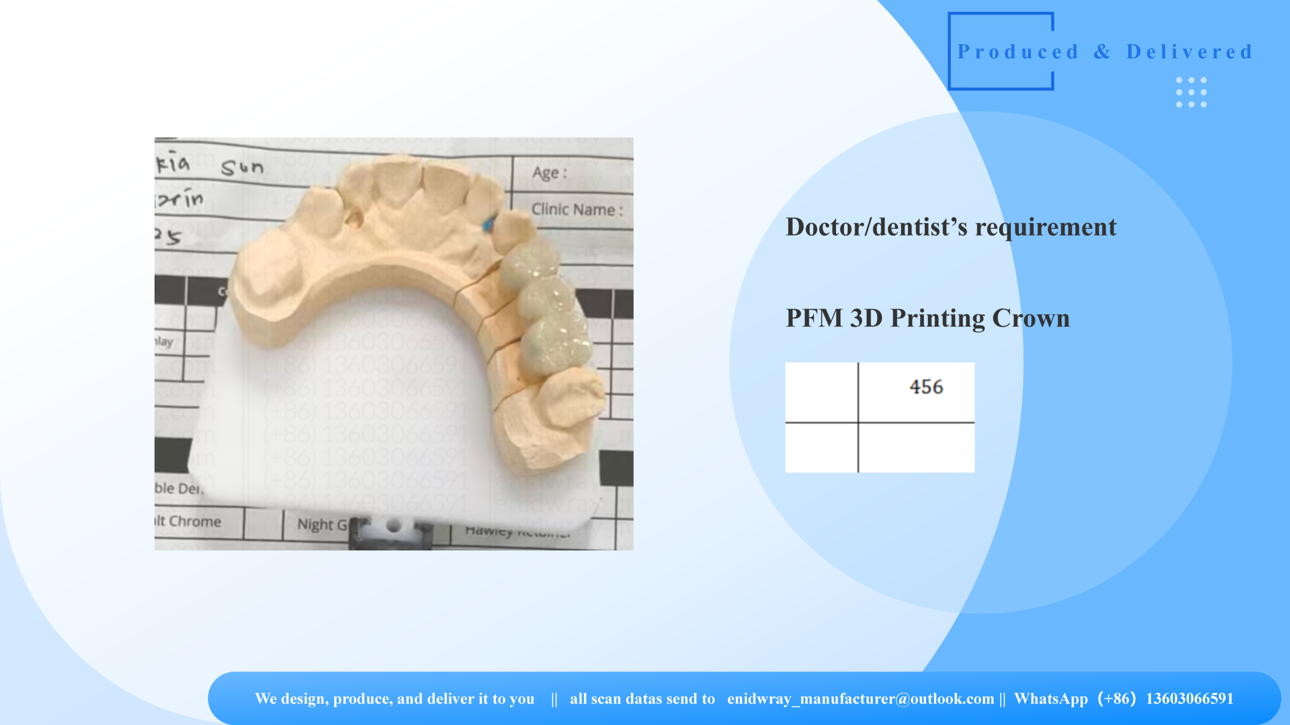 3D-Printed PFM Crown